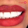 جرم گیری و بروساژ دندان توسط دکتر لشگری